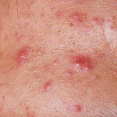 Trị mụn sưng đỏ cấp tốc tại zozo spa