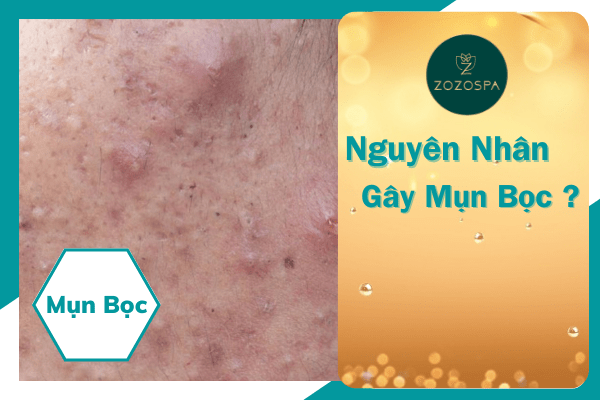 Nguyên nhân gây ra mụn bọc cách trị mụn bọc dứt điểm